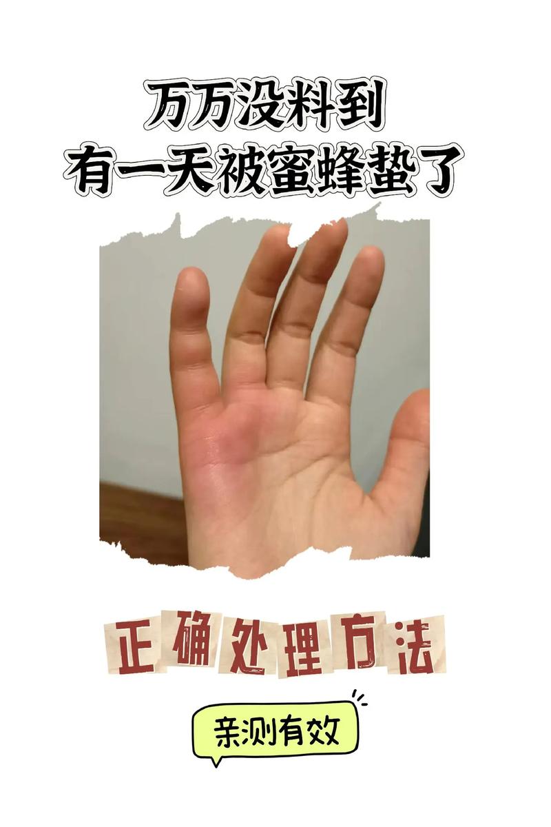 被蜜蜂蜇了怎么办？第一时间这样做！