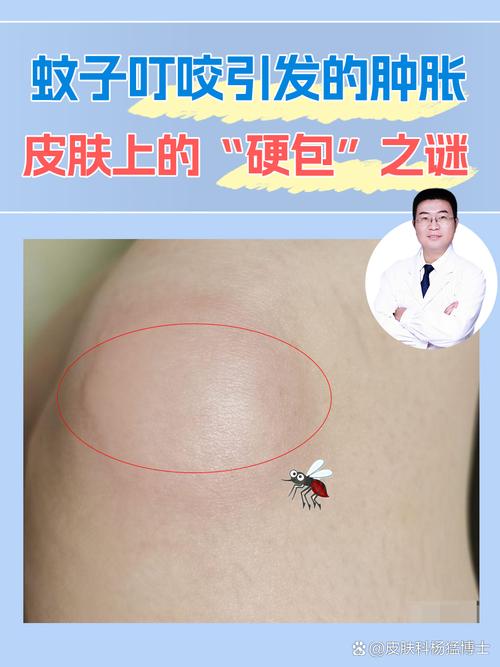 蚊子包越挠越肿的组织胺反应