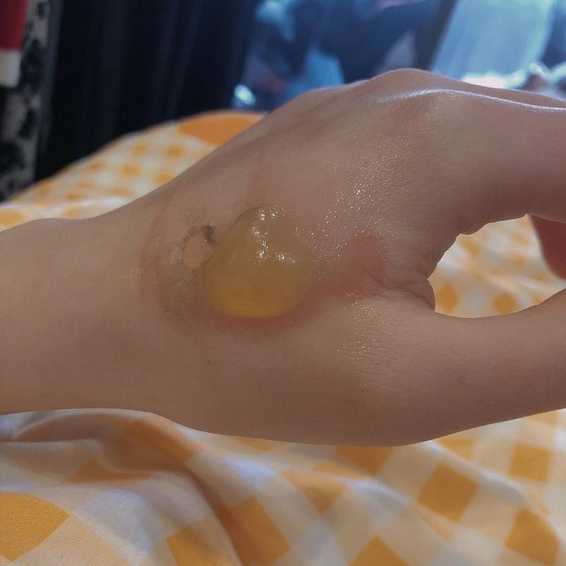 烫伤水泡挑破时机？48 小时渗出期判断