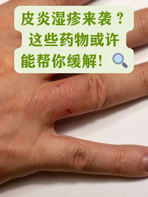 蜂蛰后全身症状处理?抗组胺药使用