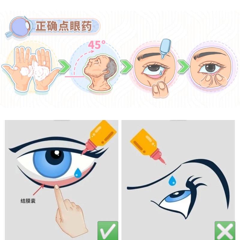 正确使用眼药水的步骤