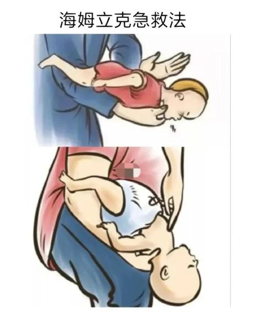孕妇海姆立克法改良？腹部冲击禁忌