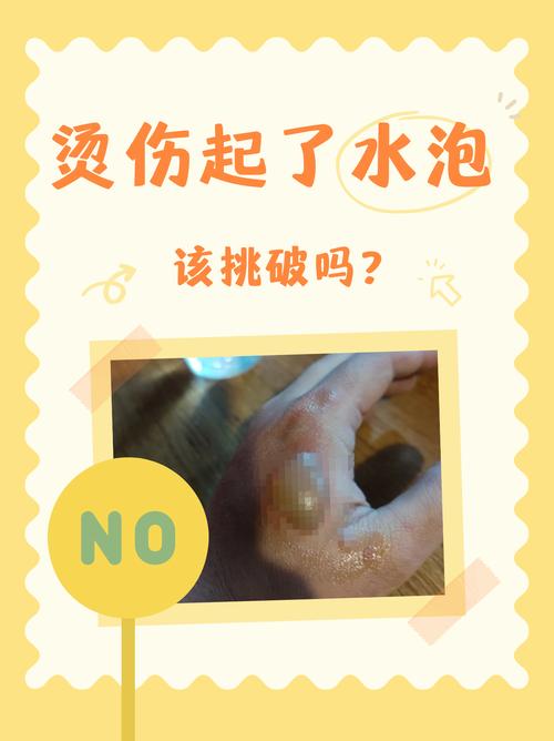 炒菜油溅烫伤？立刻冷水冲降温！